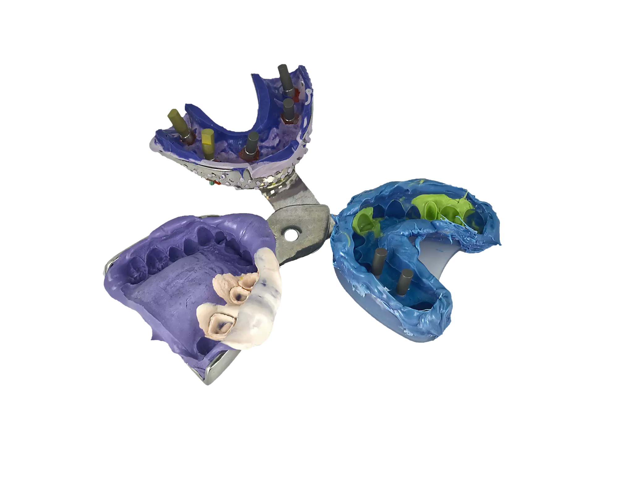 Impronte dentali con impianti e monconi
